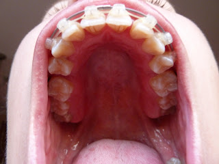 A photo of teeth with fixed ceramic braces at week 22 of treatment.