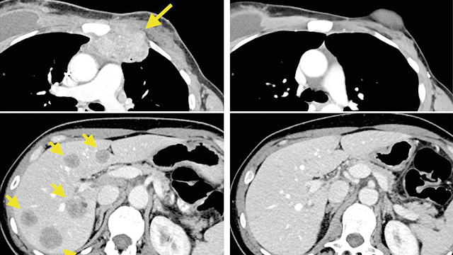 Erradican cáncer 'incurable' con nueva terapia inmunitaria experimental