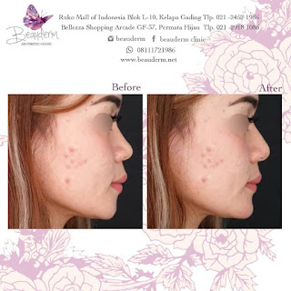 Memperindah Bentuk Dagu Dengan Filler