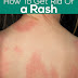 How To Get Rid Of A Rash ?