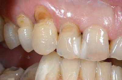 Nguy cơ mất răng khi chân răng bị mòn-1