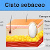 10 Remédios caseiros fáceis para remoção de cisto sebáceo naturalmente