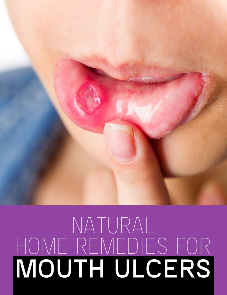 نتيجة بحث الصور عن ‪Effective natural ways treat mouth ulcers‬‏