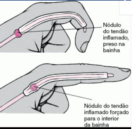 Cirurgia da mão - MANUS : "Dedo em Gatilho " - O que é, Causas, Sintomas e Tratamento