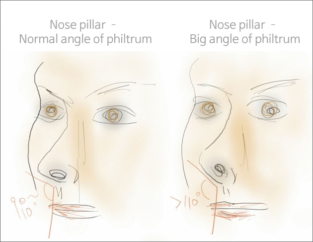 Dr. Lee Breast augmentation Korea: Short nose (upturned nose