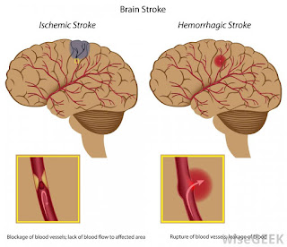 Obat stroke berat paling ampuh