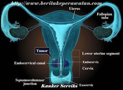 Proses Terjadinya Kanker Serviks 