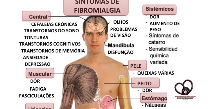 Viver Enfermagem em Cuidados Intensivos: FIBROMIALGIA ...