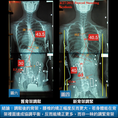 脊椎側彎, 脊椎側彎矯正, 脊椎側彎治療, 脊椎側彎矯正運動, 脊椎側彎 瑜珈, 脊椎側彎復健