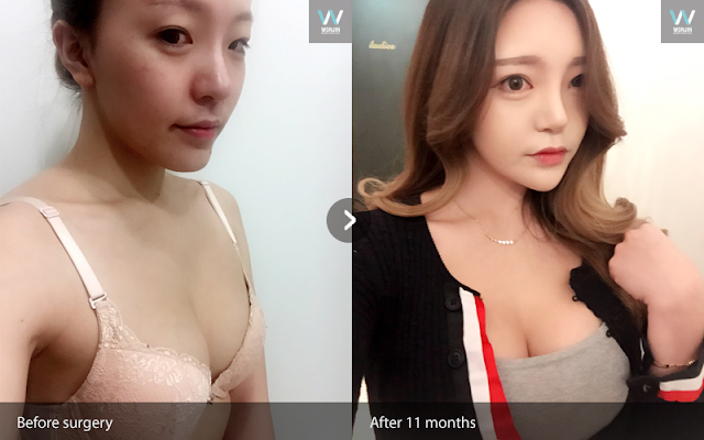 짱이뻐! - Gangnam Breast Plastic Surgery Review: Now I Love My Face Shape