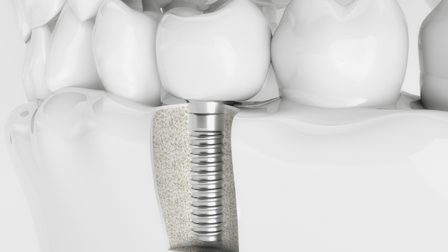 All on X Dental Implants