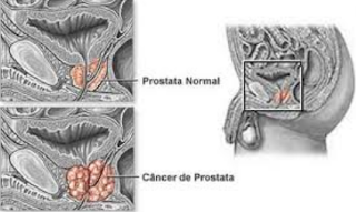 knowing prostate cancer