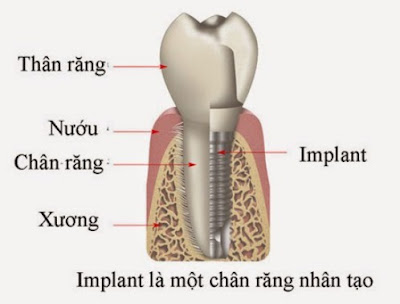 Cấy ghép Implant theo tiêu chuẩn quốc tế