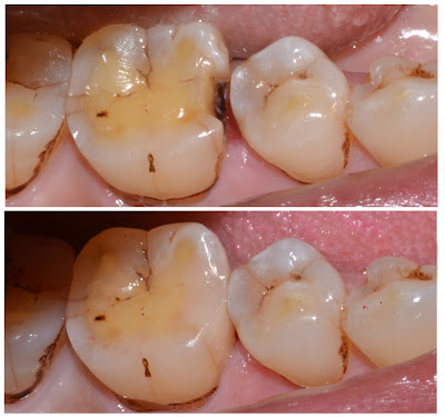 Composite Filling for Proximal Dental Caries Class 2