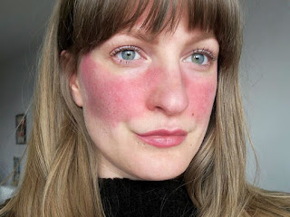 Como Aliviar La Rosacea