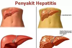 Hepatitis
