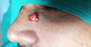 Surgery of Sebaceous Cyst