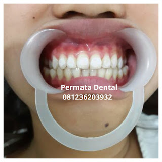 gambar foto behel bracket kawat gigi sebelum dan sesudah perawatan untuk memperbaiki merapikan gigi gingsul gigi miring renggang tonggos berantakan keluar masuk jarang diastema maju mundur tidak rapi tidak beraturan bali denpasar banyuwangi jember tidak rata kocar kacir