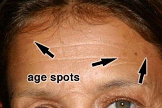 prevent age spots