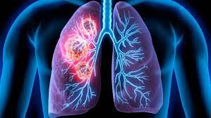 Lungs Cancer