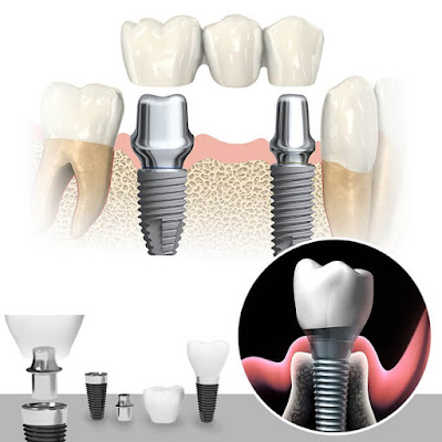 Khách hàng chia sẻ kinh nghiệm làm răng implant tới bạn-1