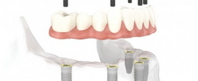 Cấy ghép răng Implant nha khoa được thực hiện như thế nào ?