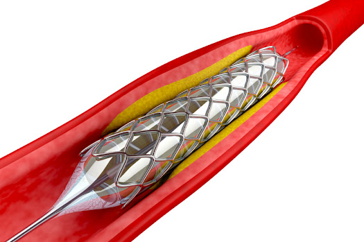 Biodegradable Stents