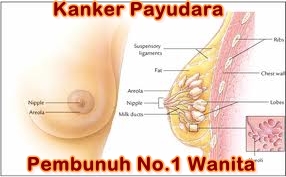 Obat Kanker Payudara Alternatif Terbaik 2013