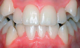 <Img src ="apiñamiento- dental-inferior.jpg" width = "490" height "299" border = "0" alt = "Apiñamiento dental en maxilar superior e inferior">