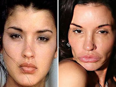 worst plastic surgery