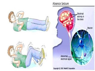 penyebab penyakit ayan atau epilepsi