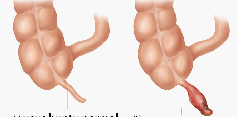 Penyebab Dan Gejala Usus Buntu Serta Penanganannya