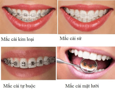 Các loại niềng răng và chi phí niềng răng 1