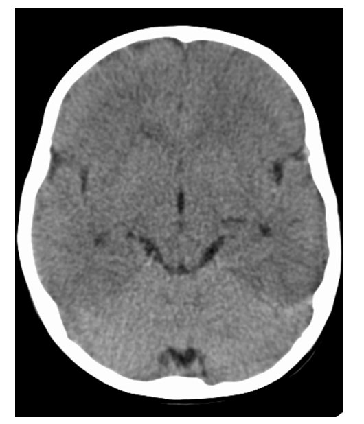 Brain Edema2