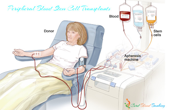 Peripheral Blood Stem Cell Transplants