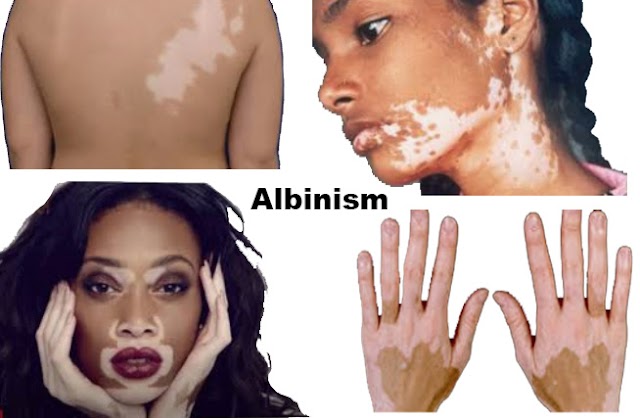 Albinism: Causes, Signs and symptoms, Test and Treatment.