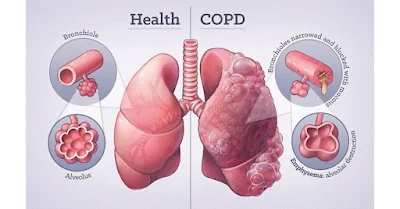 COPD Disease: परिभाषा, प्रकार, कारण व रोकथाम के उपाय