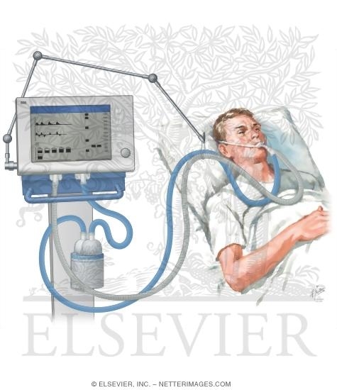 Mechanical Ventilation Management | eNurse CarePlan