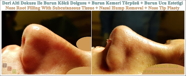 Nasal root filling with subcutaneous tissue - Nasal root filling with underskin tissue - Nose tip plasty - Limited nasal hump removal - Limited nasal hump reduction - Rhinoplasty without breaking the bone - Nose tip plasty in men Istanbul - Nose tip surgery in Istanbul - Nose tip plasty in Turkey - Nose tip plasty in women Istanbul