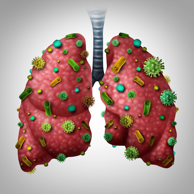 Pneumonia: Causes, Symptoms, & Treatment