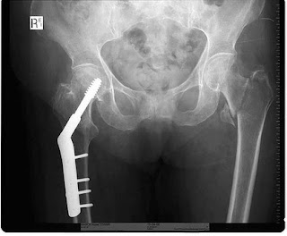 COMMON OSTEOPOROSIS DRUGS ARE ASSOCIATED WITH A DECREASE IN RISK OF BREAST CANCER