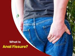 All You Need to Know About Anal Fissures: Causes, Symptoms, and Remedies All You Need to Know About Anal Fissures: Causes, Symptoms, and Remedies