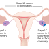 How to Know Ovarian Cancer Signs Symptoms and Treatment