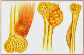  El cáncer de huesos : causas, síntomas, Diagnóstico, tratamiento y pronóstico