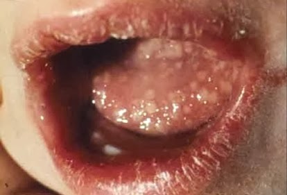 cara mengatasi penyakit herpes