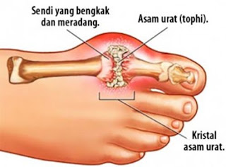 Pengobatan tradisional sakit asam urat, asam urat orang normal, efek asam urat naik, asam urat dan rematik sama, cara mengatasi nyeri akibat asam urat, cara mengatasi kelebihan asam urat, buah obat asam urat tradisional, makanan utk asam urat dan kolesterol, bekam penyakit asam urat, apa itu asam urat dan cirinya, asam urat yang mengkristal