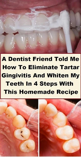 How To Eliminate Tartar, Gingivitis, And Whiten My Teeth In 4 Steps With This Magical Trick