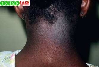 Fig. 5.14 Atopic dermatitis, lichenification