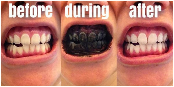 5 Cara Memutihkan Gigi yang Kuning dengan Cepat Secara 