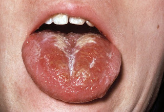 Severe rash on the tounge, infection caused by scarlet fever